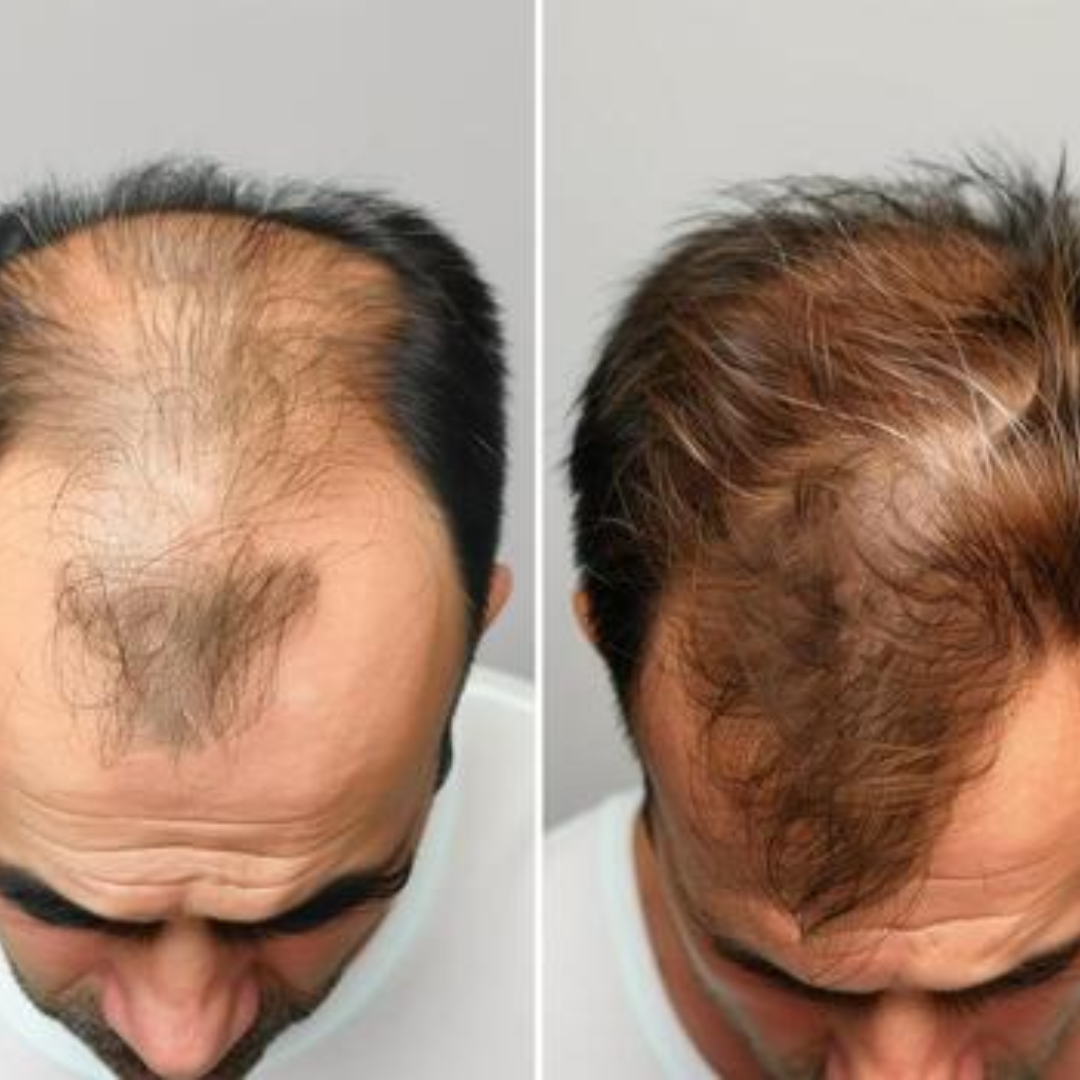Proskire Hair Growth Serum – Reduces Hair Fall & Boosts Hair Density