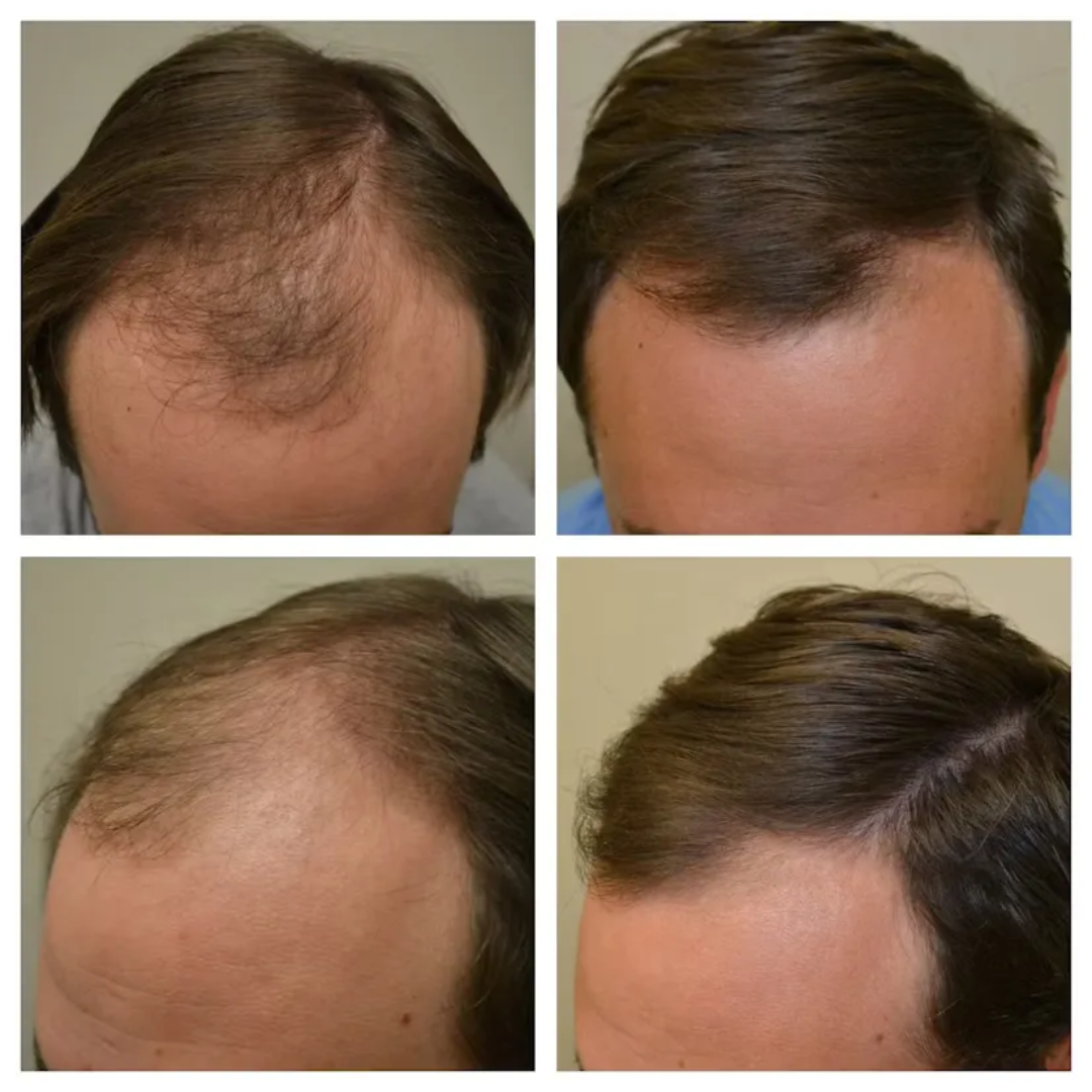 Proskire Hair Growth Serum – Reduces Hair Fall & Boosts Hair Density