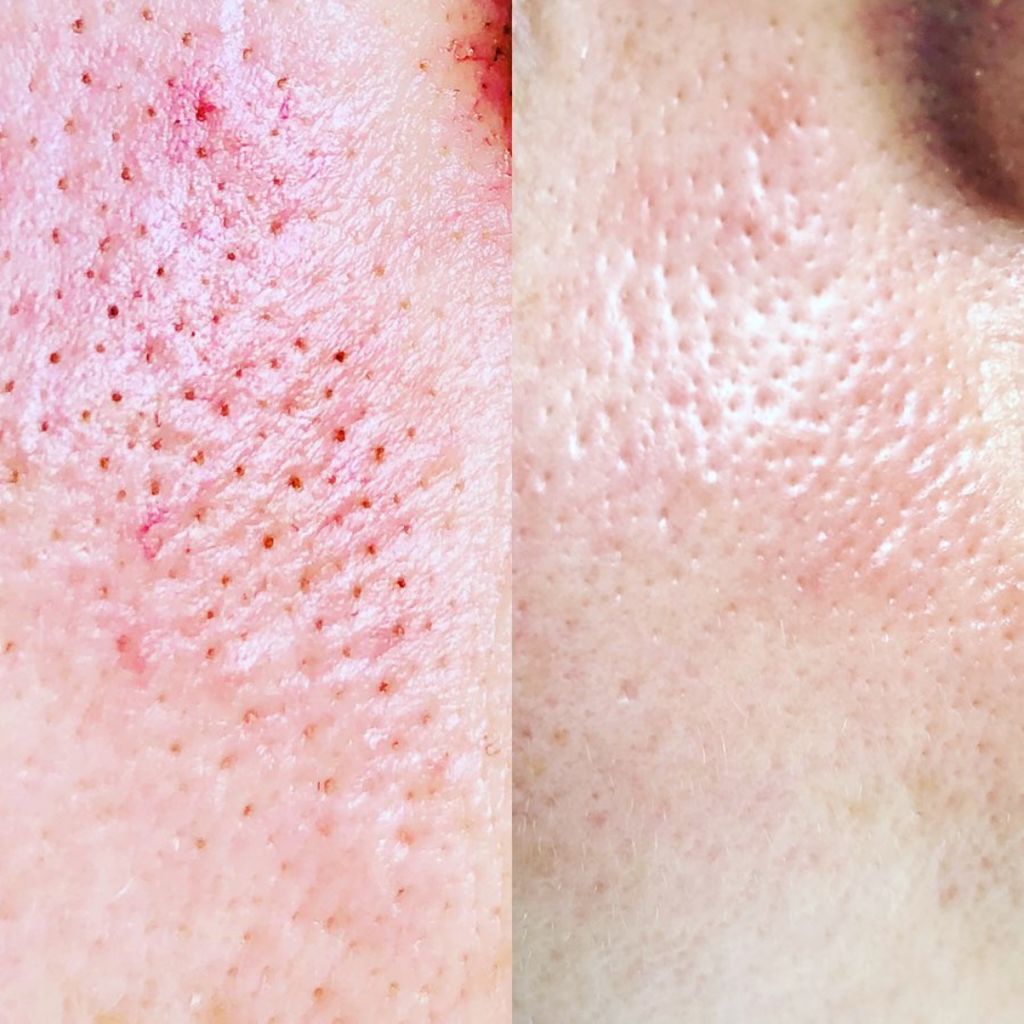 2-in-1 Rice  mask & cleanser (Remove black & white heads , tightening pores and give instant clean & bright skin tone)