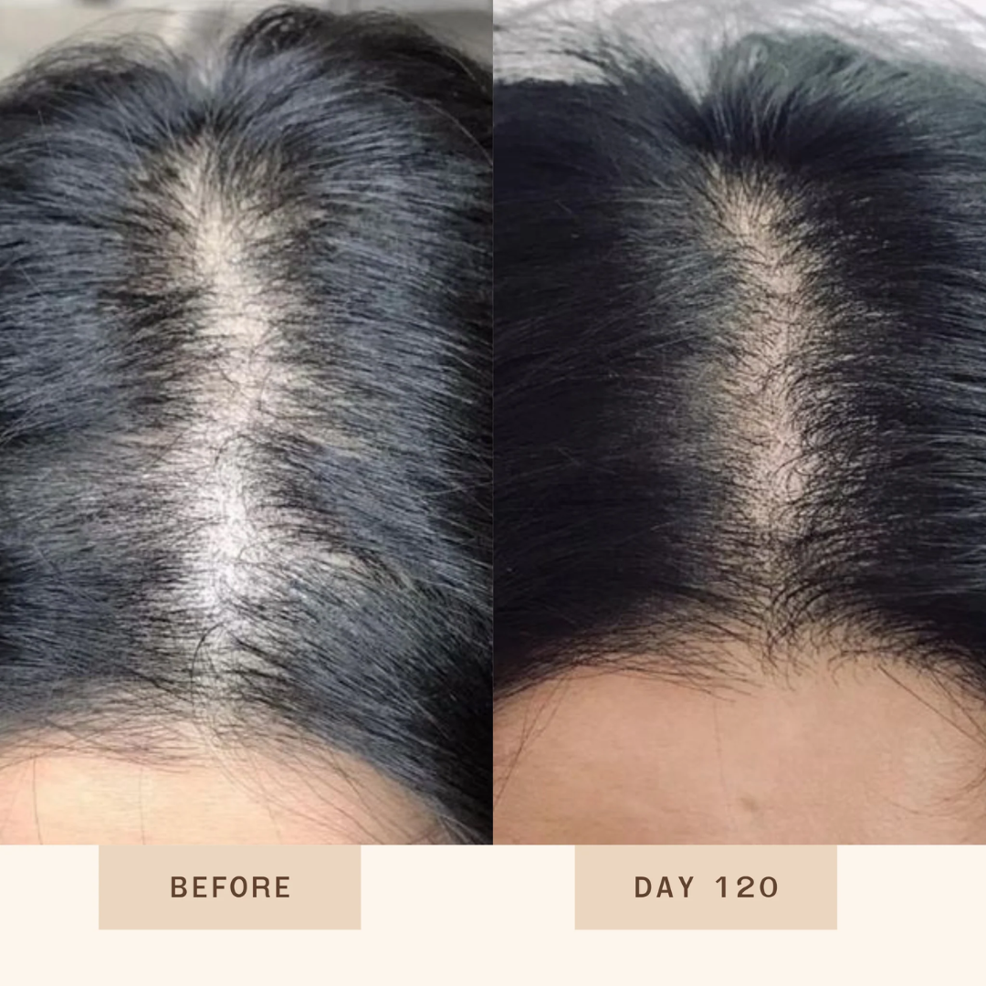 Proskire Anti-Grey Hair Serum – Reverses Grey Hair, Reduces Hair Fall & Restores Hair Color