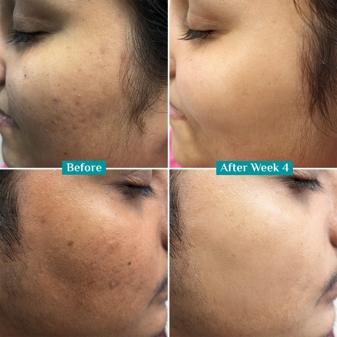 Teashell Niacinamide Brightening Serum | 5% Niacinamide + Alpha-Arbutin + Ascorbyl Acid | Fades Dark Spots, Evens Skin Tone & Boosts Glow