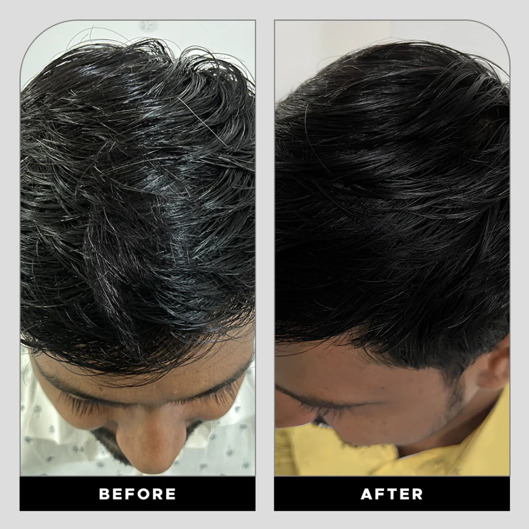 Proskire Anti-Grey Hair Serum – Reverses Grey Hair, Reduces Hair Fall & Restores Hair Color