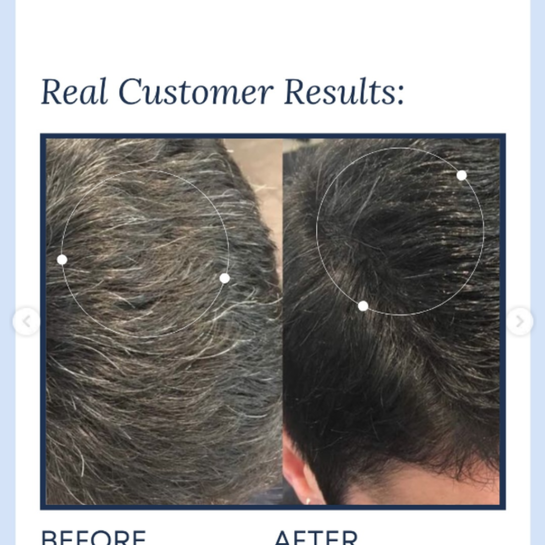 Proskire Anti-Grey Hair Serum – Reverses Grey Hair, Reduces Hair Fall & Restores Hair Color